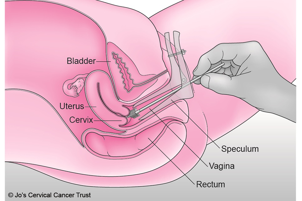 Jo's cervical Cancer Trust image of a cervical screening examination with a speculum